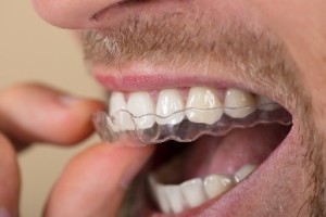 L'orthodontie invisible à Aix en Provence